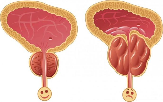 healthy prostate and inflamed prostate