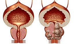 Healthy and non-healthy prostate