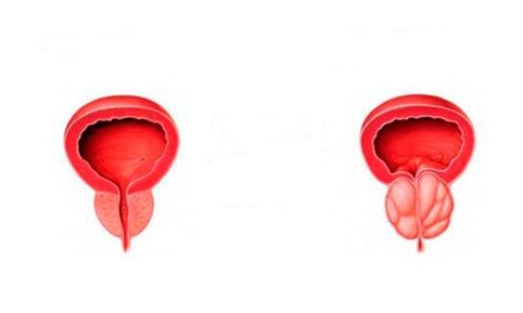 healthy prostate and inflamed prostate