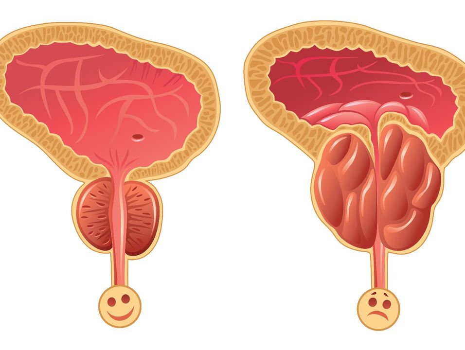 Healthy prostate gland and prostate congestion with congestive prostate