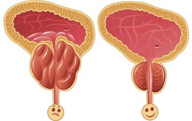 how does Prostalix work for prostatitis before and after treatment